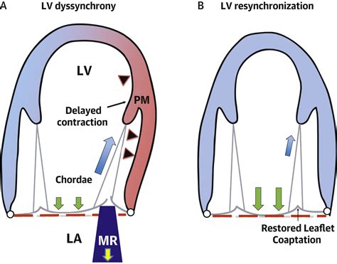 lv dyssynchrony|ventricular dyssynchrony life expectancy.